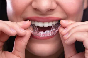 Picture of Invisalign Clear Braces