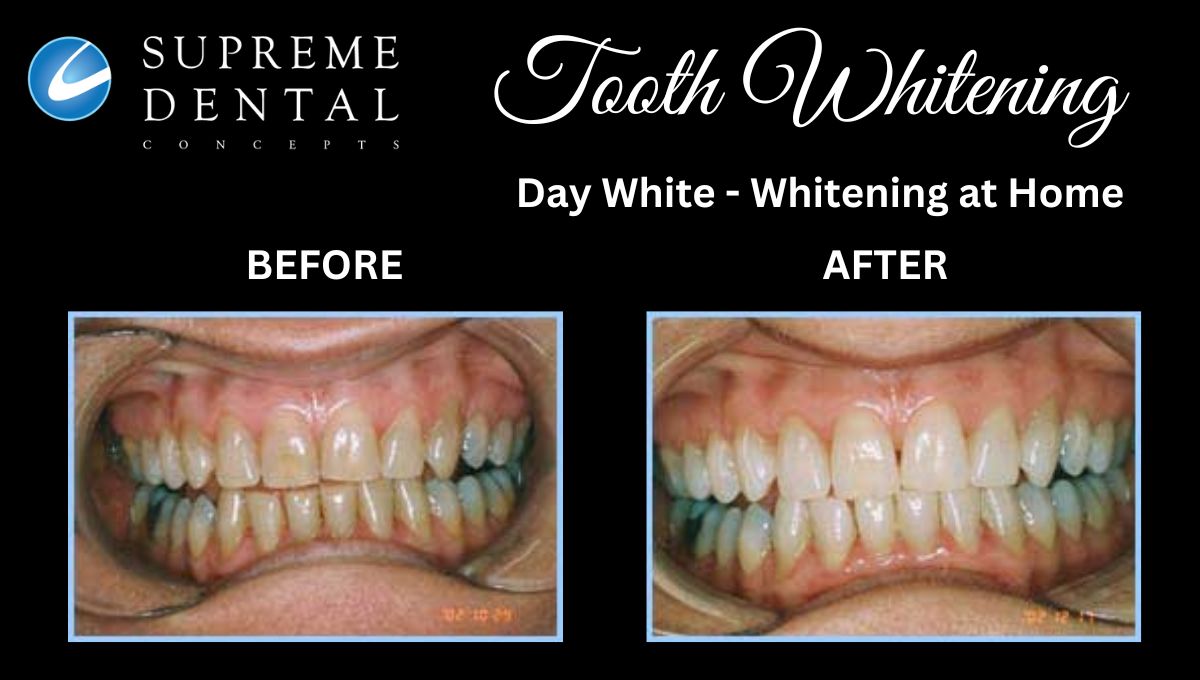 Day White Tooth Whitening