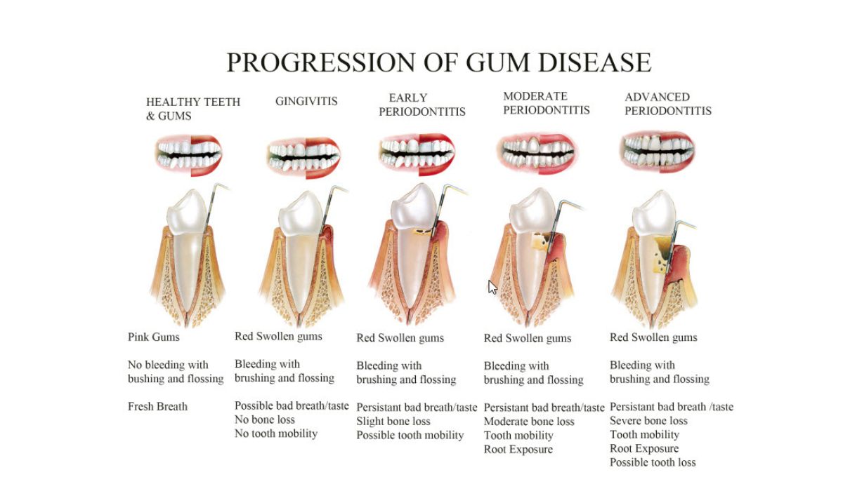 Gum Disease Progression 1