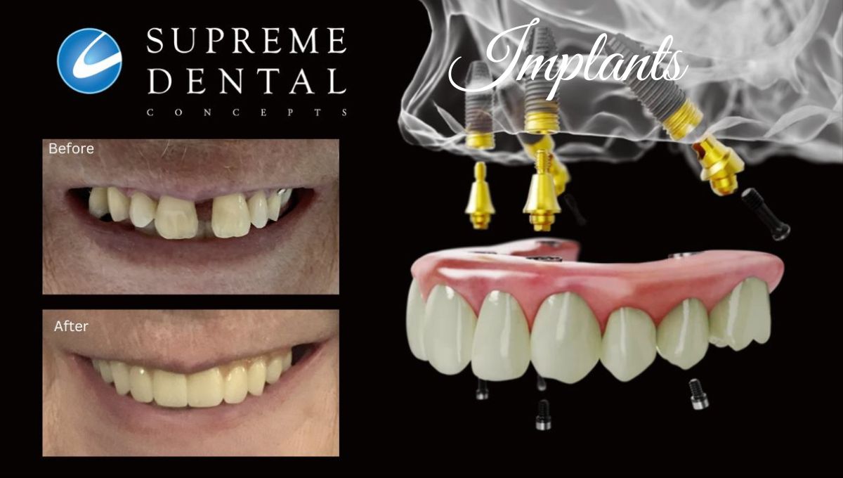 Implants Before And After