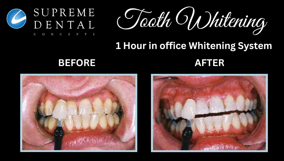 In Office Tooth Whitening System