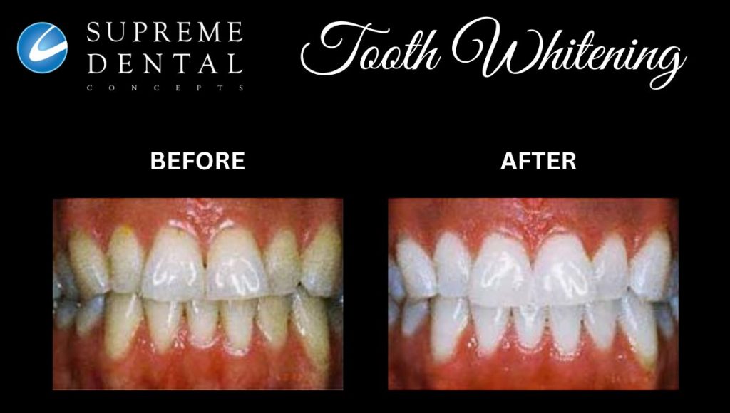 Teeth Whitening Supreme Dental Concepts Wellington