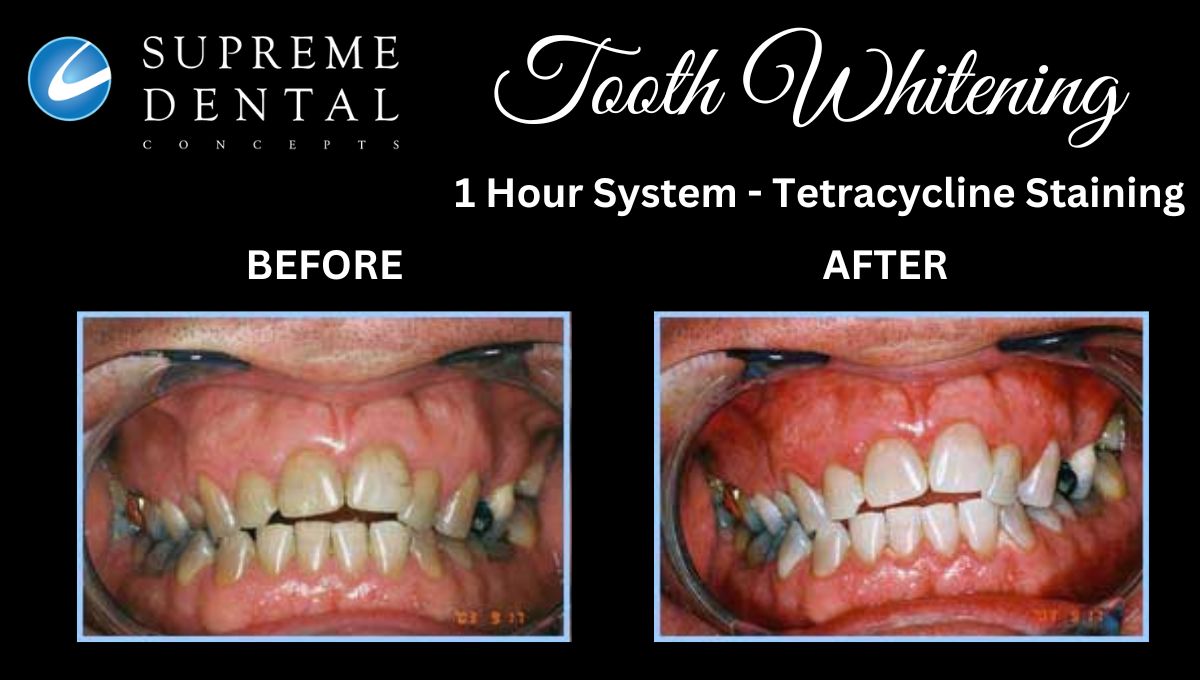 Tooth Whitening For Tetracycline