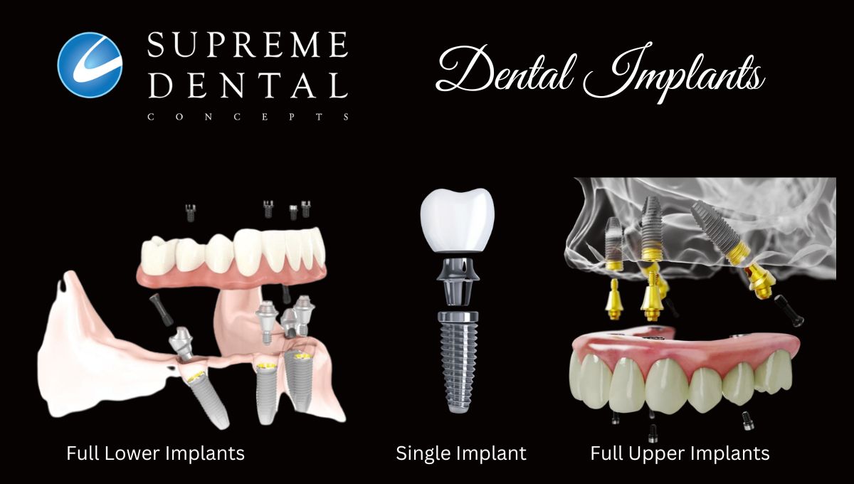 Dental Implant Range
