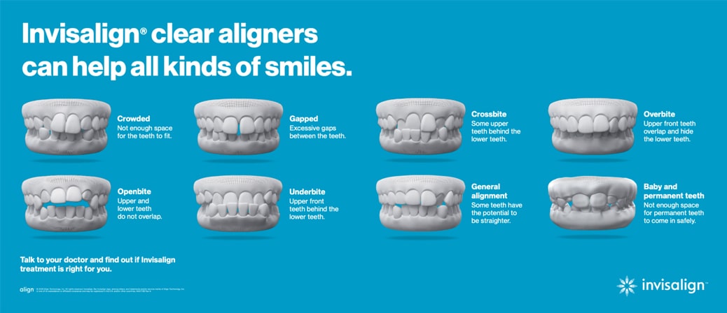 Invisialign Clear Aligners Helps All Kinds Of Smiles Chart Min