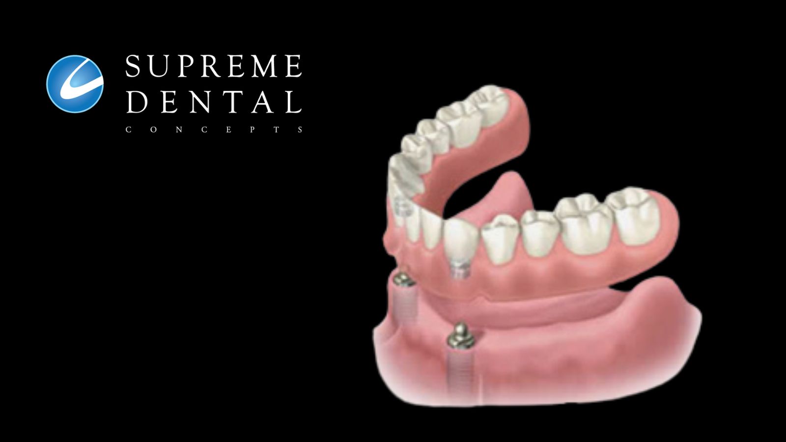Dental Implant Denture Stablization