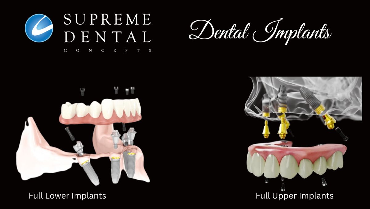 Dental Implants Fixed