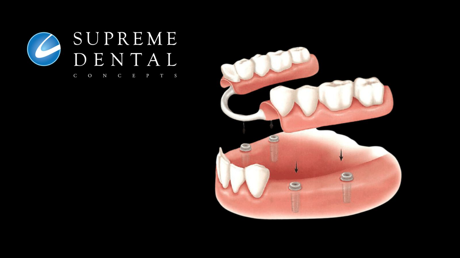 Partial Denture Dental Implants