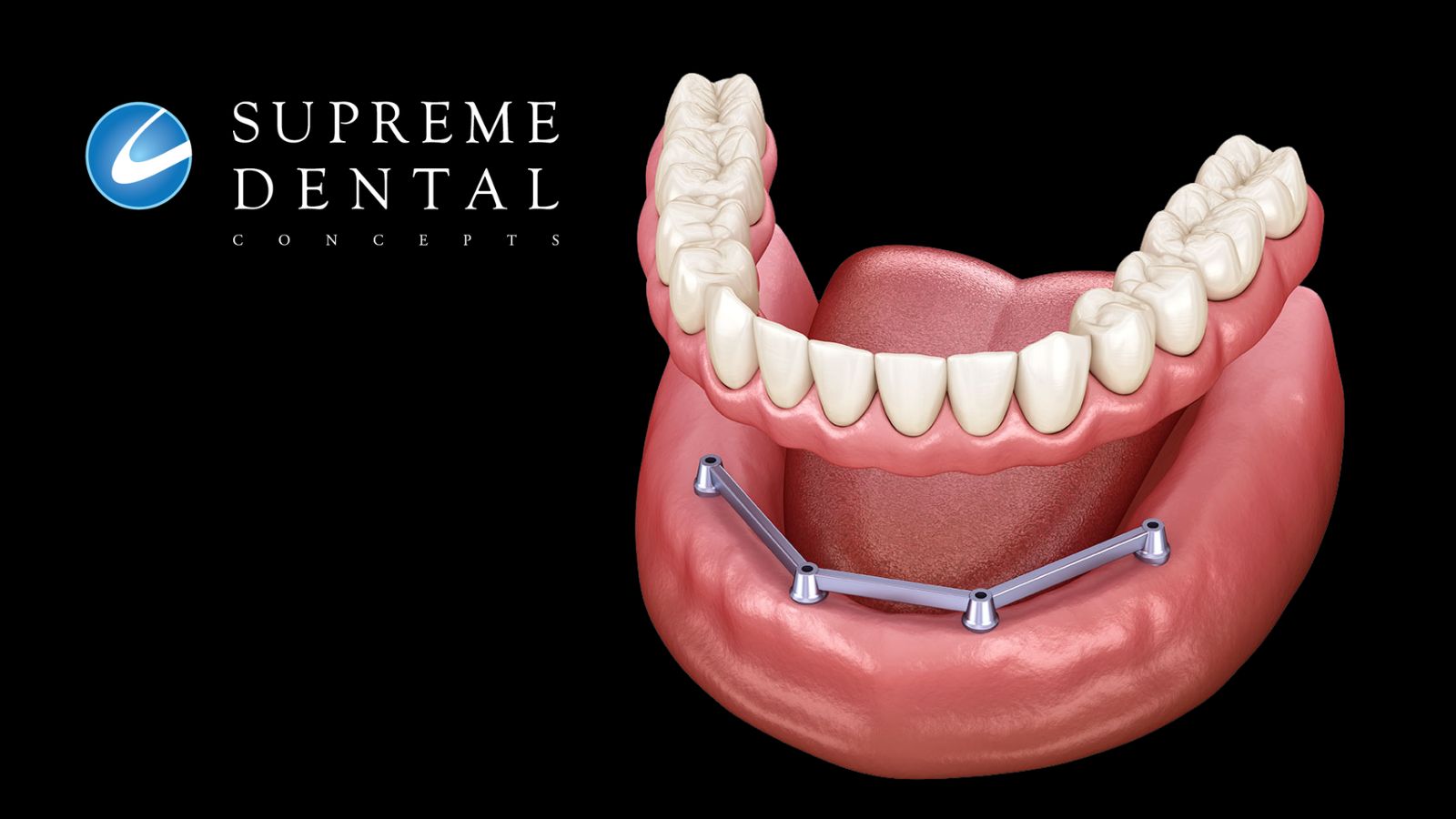 Removable Dental Implant Prosthesis